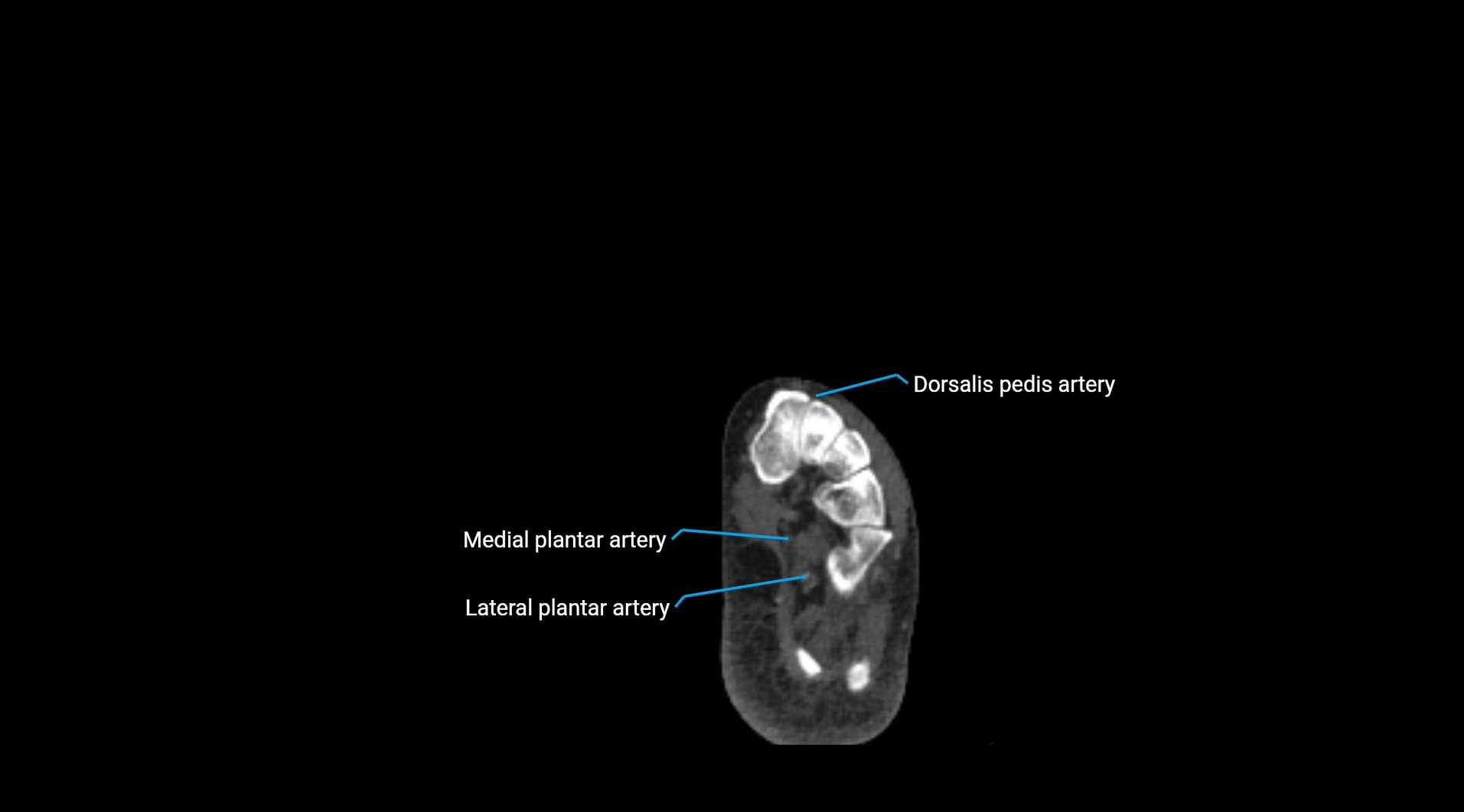 CTA lower limb cross sectional anatomy labelled image _287.webp